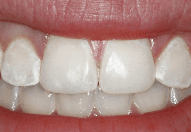 white spots on your teeth