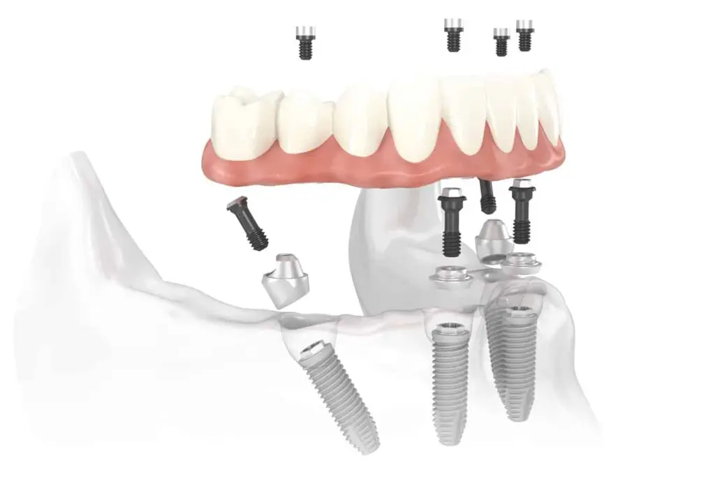 Full-Arch Dental Implants Procedure