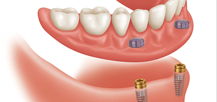 Dental Implants Coral Gables and Plantation
