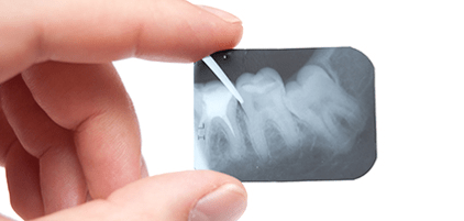 Root Canal Therapy Coral Gables