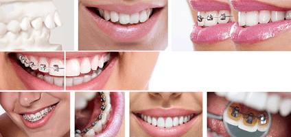 Orthodontics and types of braces - Miracle Smile Plantation and Coral Gables, FL