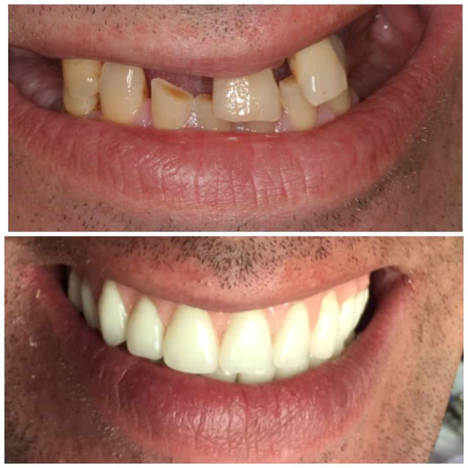 All On Four Dental Implants