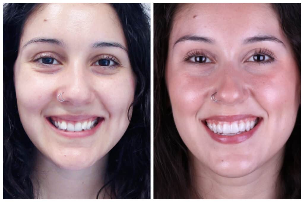 Dr. Aller invisalign patient - before and after