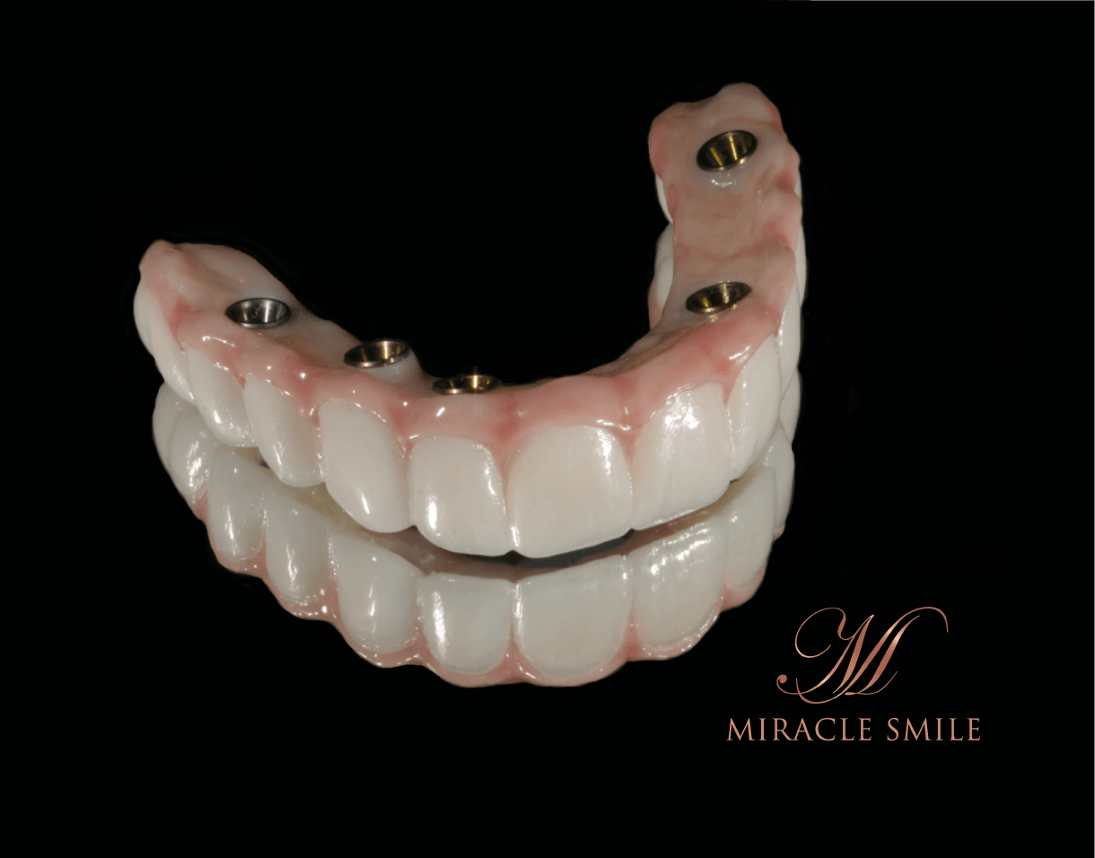 All-On-4 Dental Implants Service