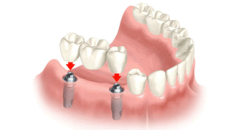 Dental Implants - Miracle Smile Dentistry